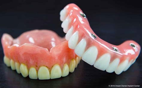 affordable dentures implants|affordable dentures & implants locations.